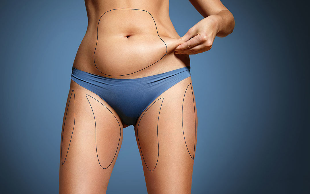 Subcutaneous versus Visceral Fat: Which Can Liposuction Remove?