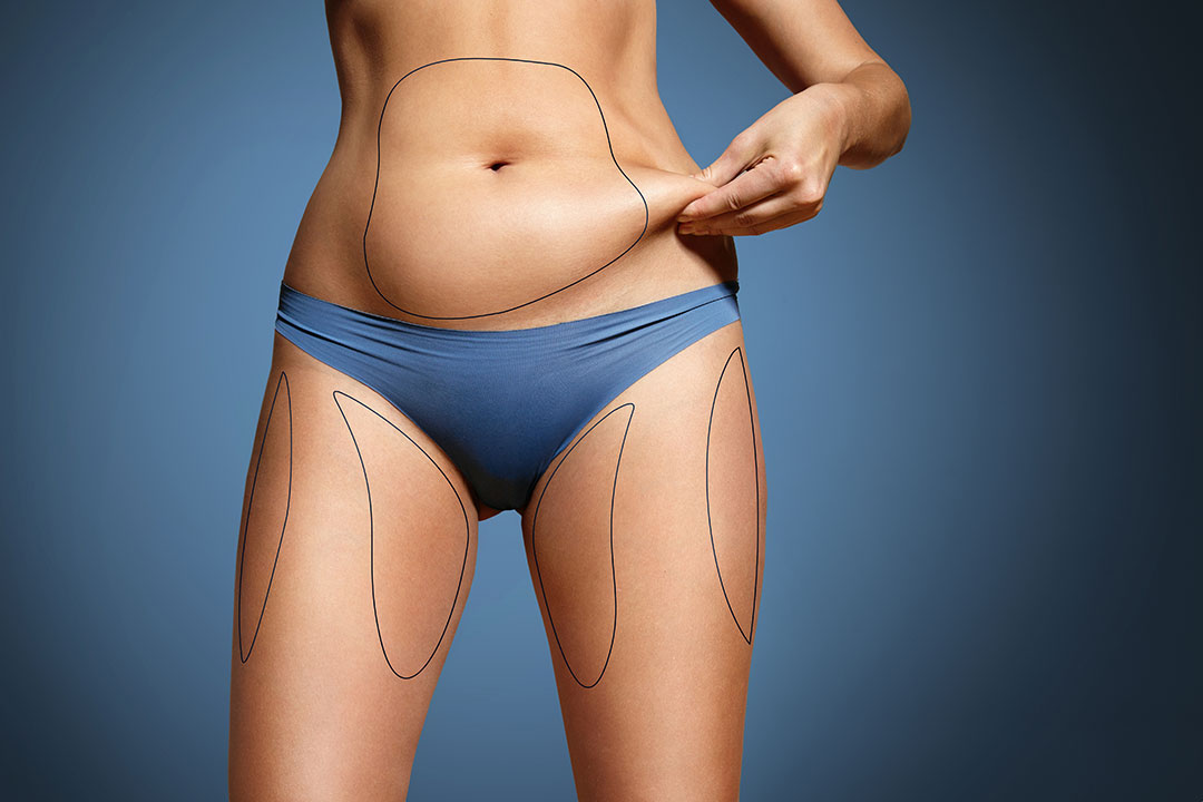 Subcutaneous versus Visceral Fat - Liposuction - Dallas, TX