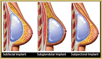 Breast Implants – Over or Under the Muscle?