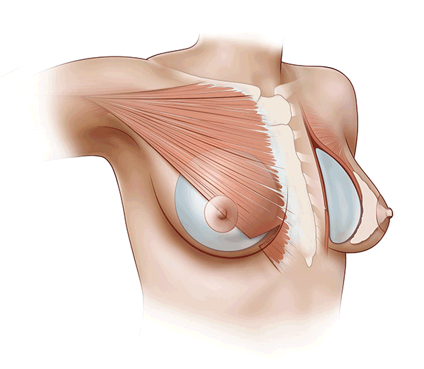 Over Muscle vs Under Muscle Implants