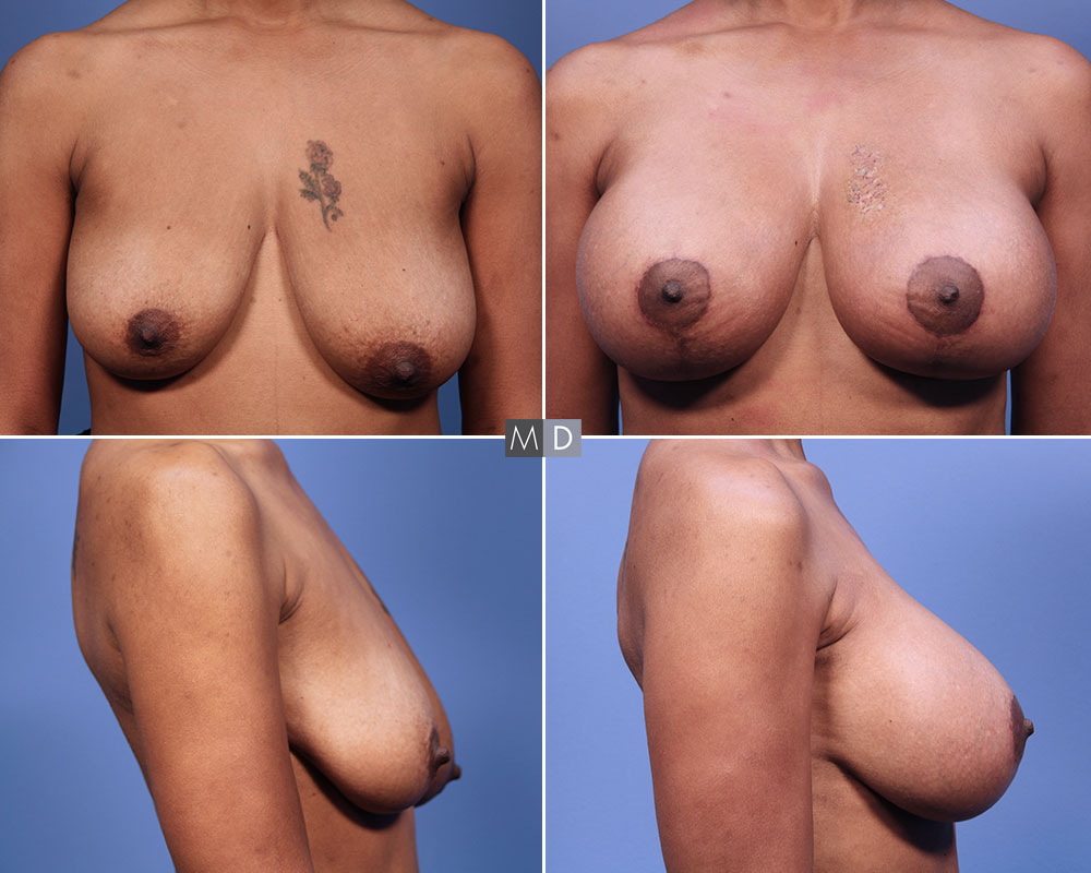 Dr Mark Deuber MD Breast Augmentation with Lift Before and After
