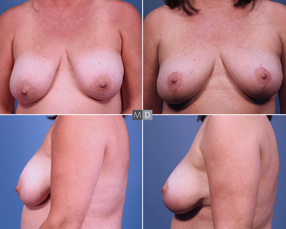 Dr Mark Deuber MD Breast Lift Before and After