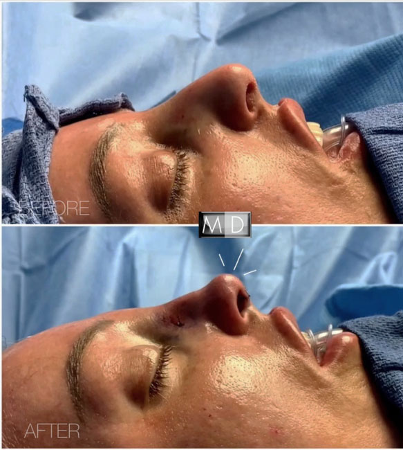 Dr Mark Deuber MD Rhinoplasty Before and After