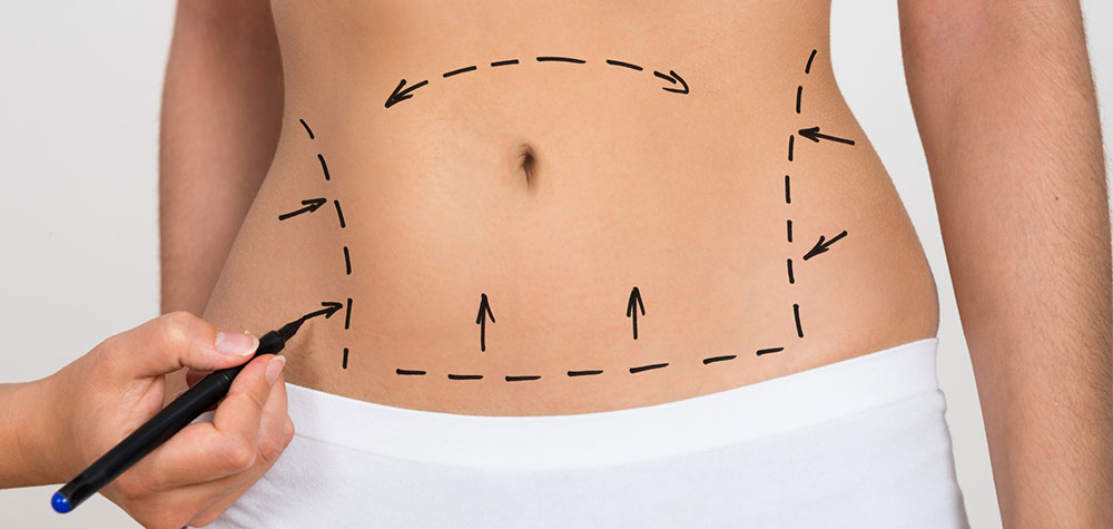 Surgeon Makring woman's abdomen -Tummy Tuck with Liposuction