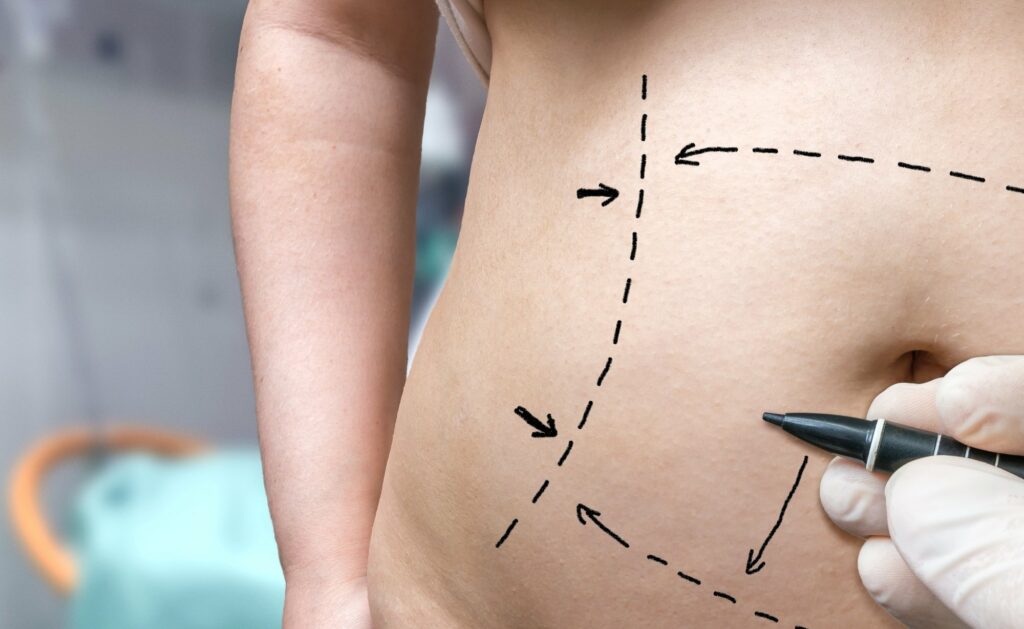 Tummy Tuck With Lipo: A Guide on What to Expect 