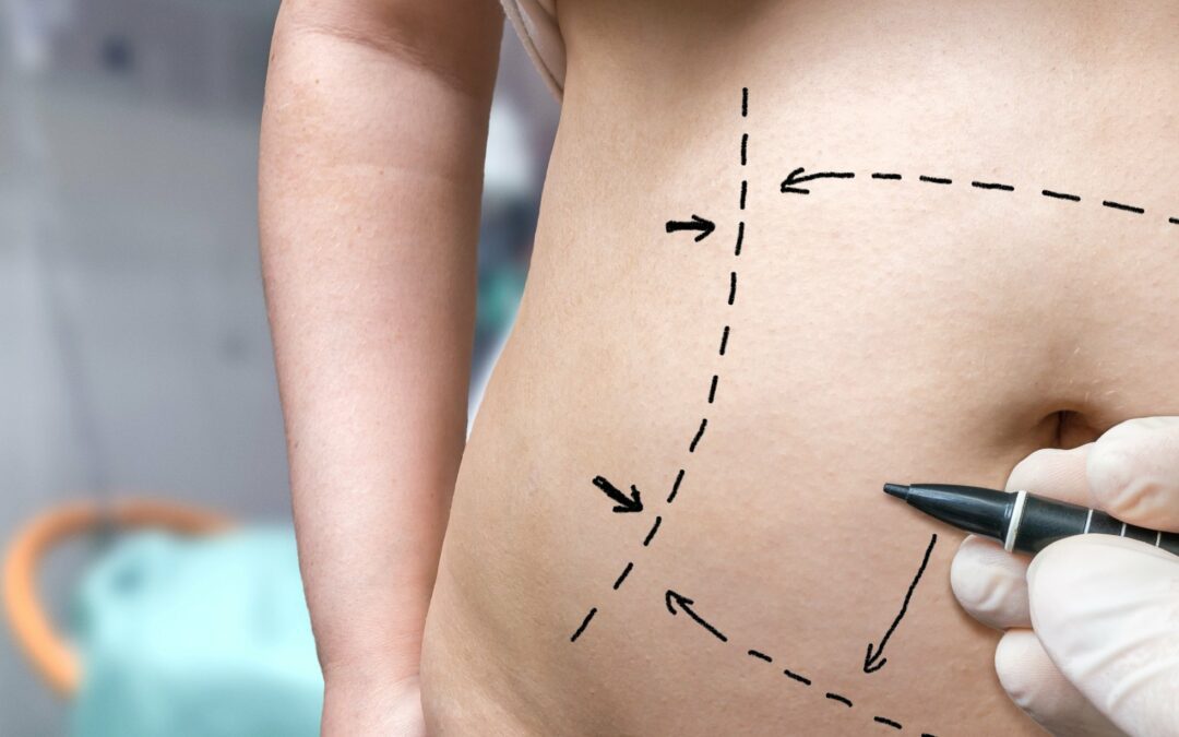 Tummy Tuck With Lipo: A Guide on What to Expect