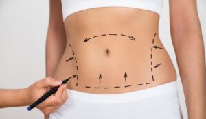 A close-up of a woman's abdomen with pre-surgical markings, highlighting fat removal areas in cosmetic surgery. Mark A. Deuber M.D - Dallas, Texas