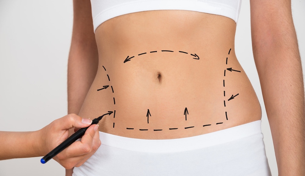 A close-up of a woman's abdomen with pre-surgical markings, highlighting fat removal areas in cosmetic surgery. Mark A. Deuber M.D - Dallas, Texas