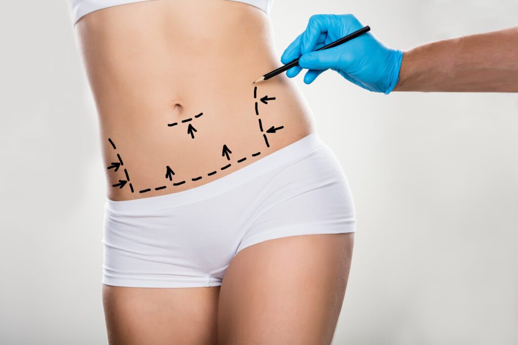 A close-up of a woman's abdomen with pre-surgical markings, highlighting fat removal areas in cosmetic surgery. Mark A. Deuber M.D -Dallas, Texas