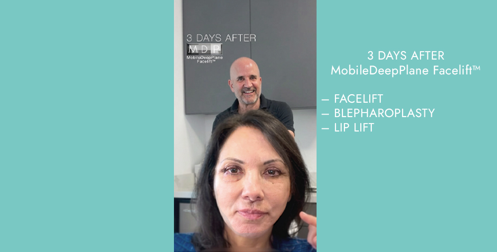 Patient three days after a MobileDeepPlane Facelift with Dr. Mark Deuber, following eyelid surgery and a lip lift