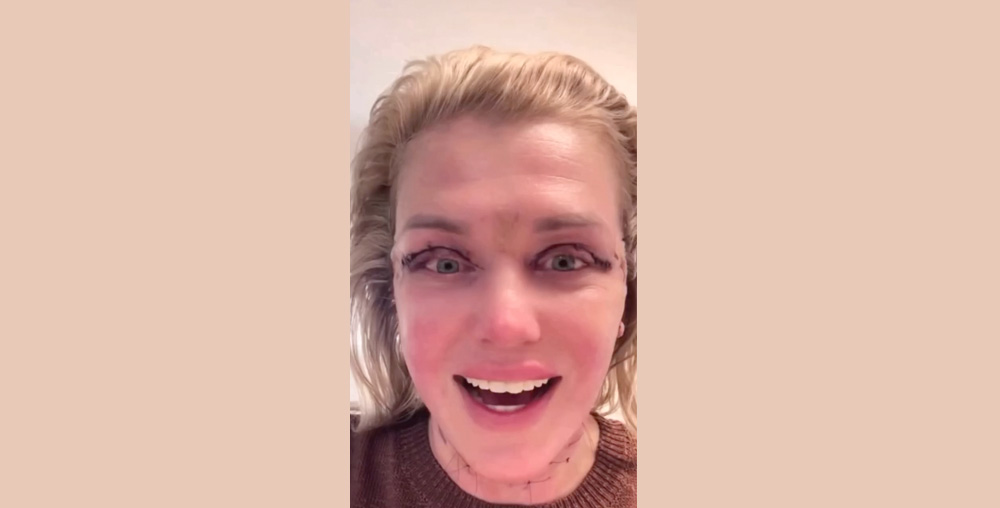 Patient one day after a MobileDeepPlane Facelift with visible swelling and early recovery changes
